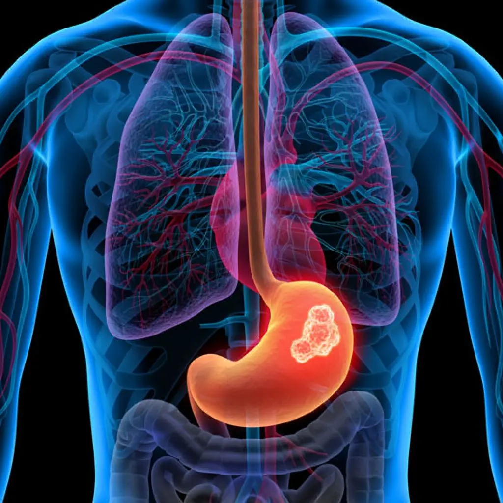 Imagen sobre "Chequeos Preventivos (Cáncer de Estómago y Colon)"